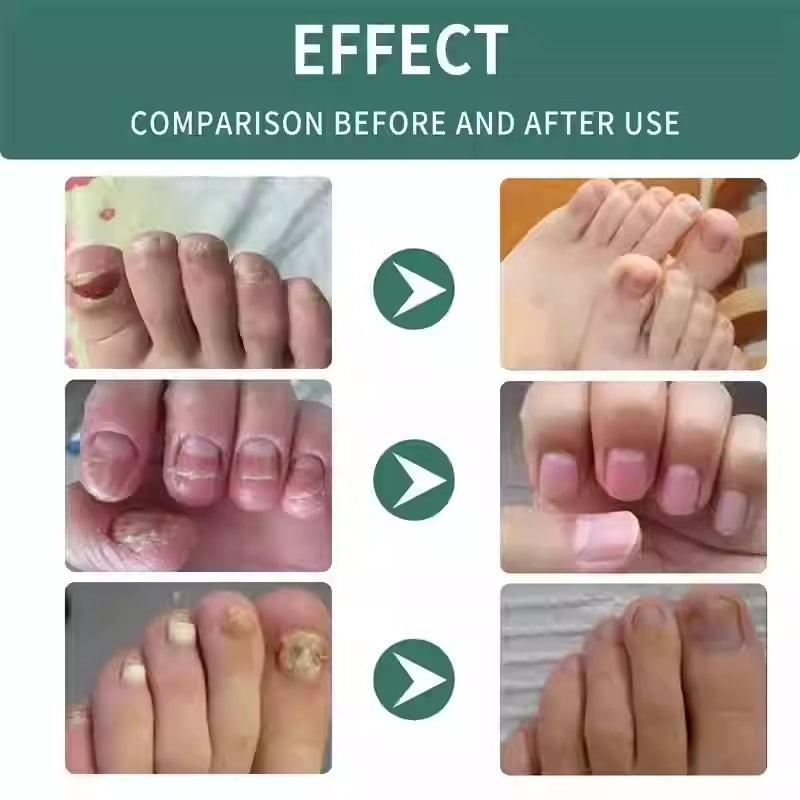 Nail Fungus Treatment Serum