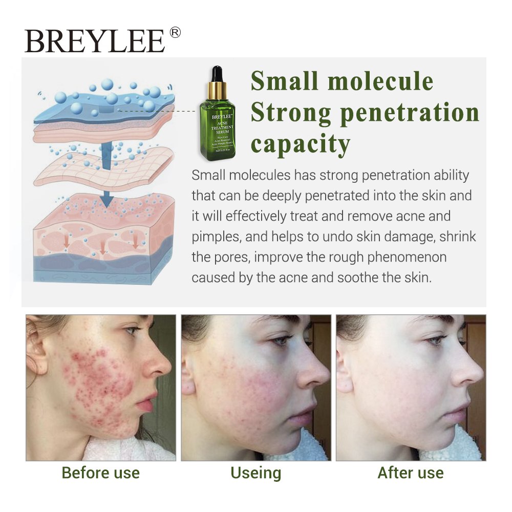 Acne Scar Removal Serum