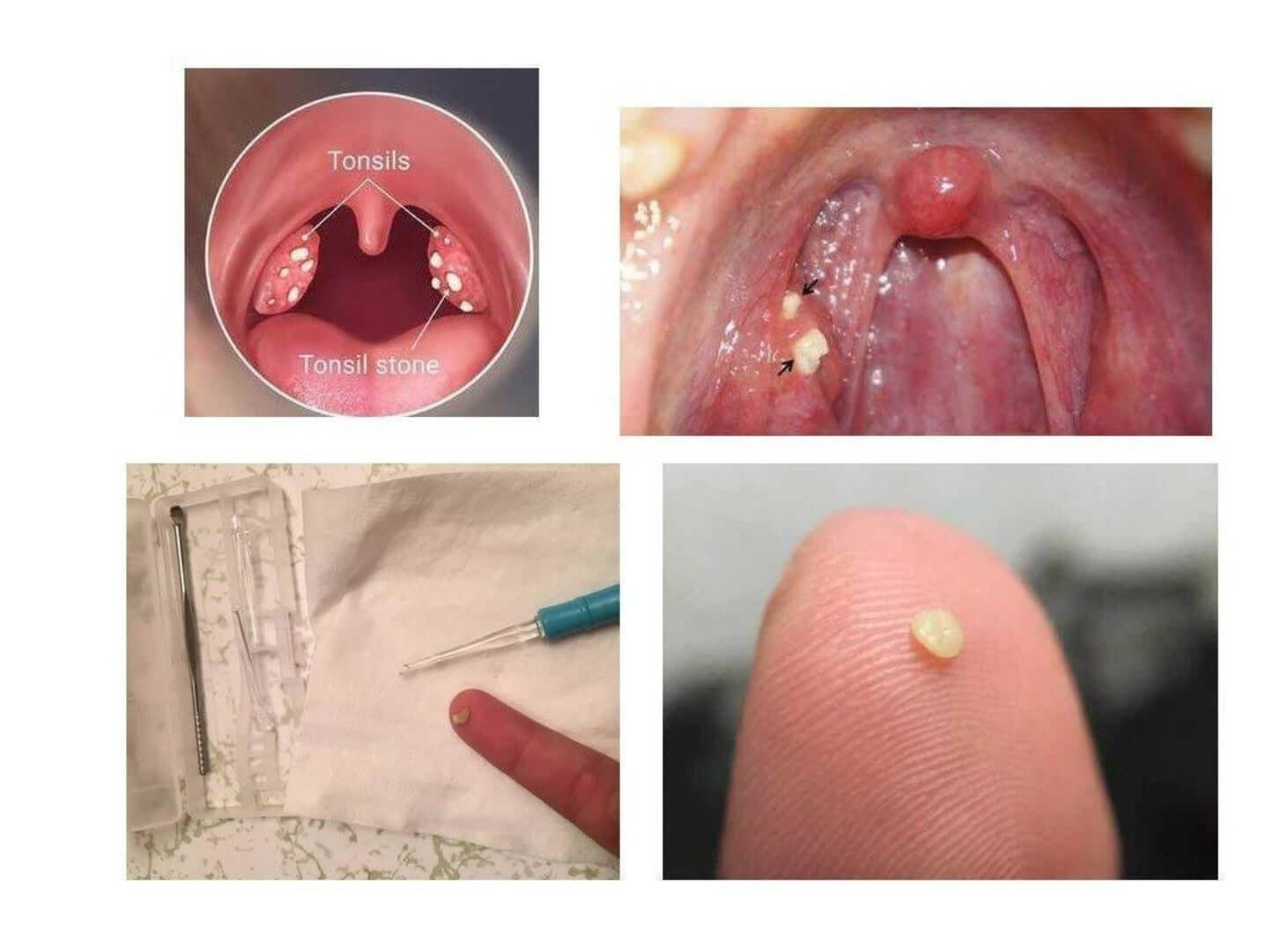 Tonsil Stone Remover Tool