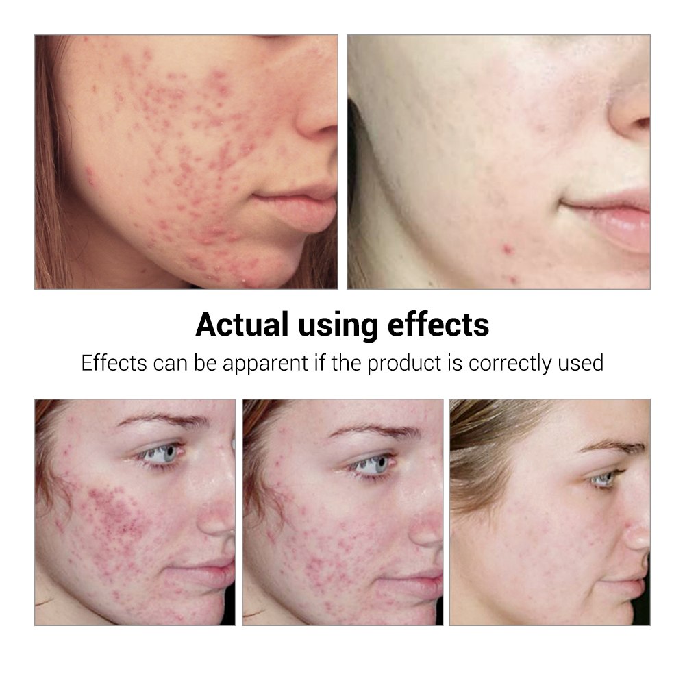 Acne Scar Removal Serum
