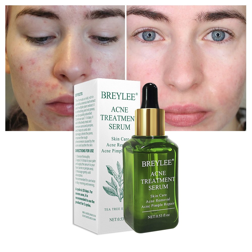 Acne Scar Removal Serum