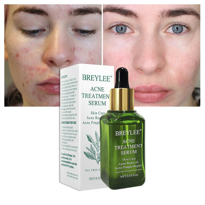 Acne Scar Removal Serum